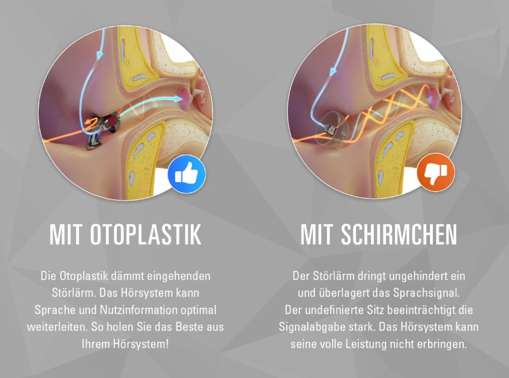 Titan Otoplastiken Ein Elementarer Baustein F r Eine Erfolgreiche Titan Otoplastiken Ein Elementarer Baustein F r Eine Erfolgreiche